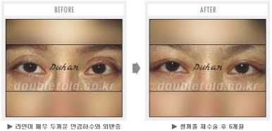 두한성형외과 쌍커풀 재수술 - 짝눈 눈매교정, 가성 안검하수 교정과 뒤밑트임 관련 이미지 58