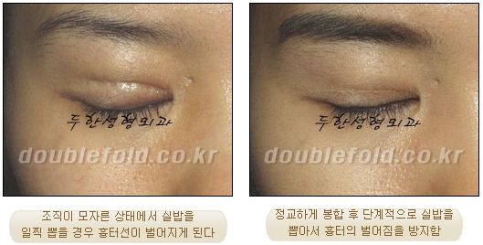 [두한성형외과 쌍수] - [재수술 실패의 원인, 재수술의 성공 요건] 관련 이미지 13