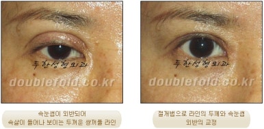 [Duhan Plastic Surgery Eye Surgery] - [Asymmetric Line, Eyelash Eversion, Deep Fixation] image 31