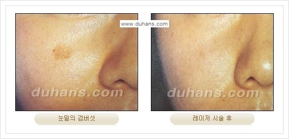 [두한성형외과 경쟁력 레이저시술] - [이산화탄소 점제거 안내] 관련 이미지 9