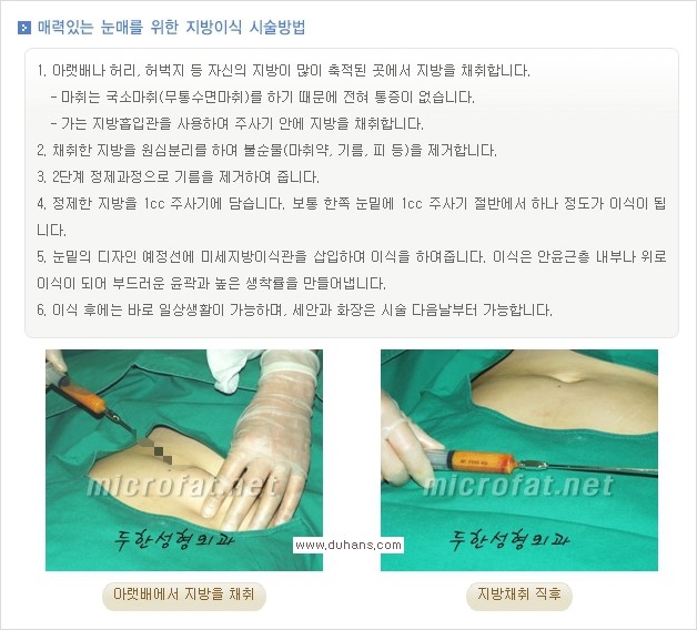 [두한성형외과 경쟁력 눈밑성형] - [눈밑 다크써클과 눈밑 애교살과의 관계] 관련 이미지 3