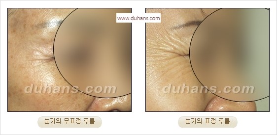 [두한성형외과 경쟁력 주름성형] - [간단하면서 자연스러운 주름제거 방법] 관련 이미지 5