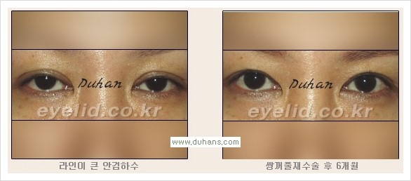 [두한성형외과 경쟁력 눈성형] - [안검하수와 몽고주름에 대한 자주하는 질문과 답변] 관련 이미지 8