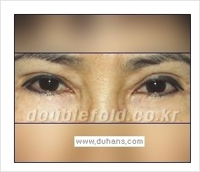 [두한성형외과 경쟁력 쌍꺼풀 재수술] - [Dr. 컬럼 - "재수술의 이상적인 목표"] 관련 이미지 8