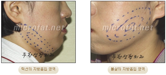 [Duhan Plastic Surgery Liposuction] - [Facial Liposuction] image 6