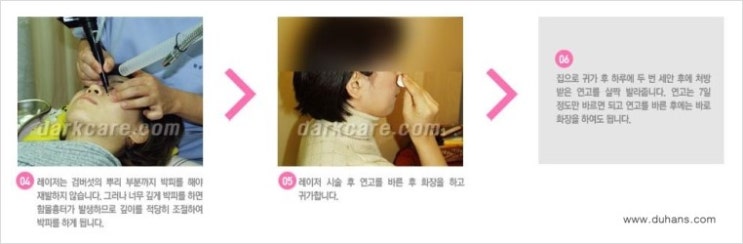 [두한성형외과 무한 경쟁력 다크써클 치료] - [다크써클 + 검버섯 레이저 콤비 프로그램] 관련 이미지 4