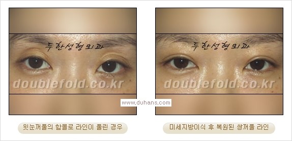 ​⁠⁠[두한성형외과 경쟁력 쌍꺼풀 재수술, 극한 눈재수술] - [지방이식으로 눈매와 쌍꺼풀 라인을 교정] 관련 이미지 17