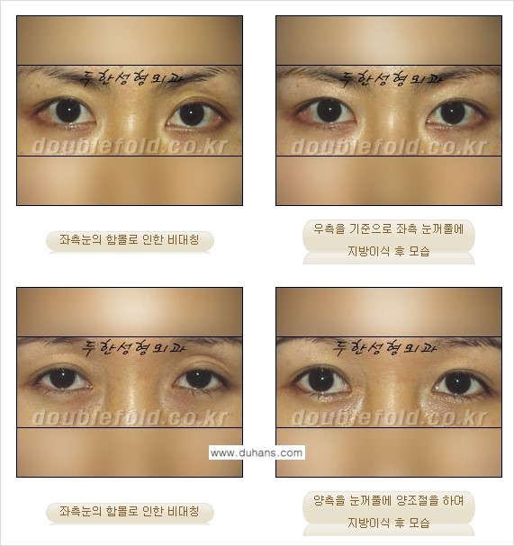 [두한성형외과 경쟁력 눈성형] - [비대칭(짝짝이) 쌍꺼풀 라인 교정 안내 ②] 관련 이미지 9