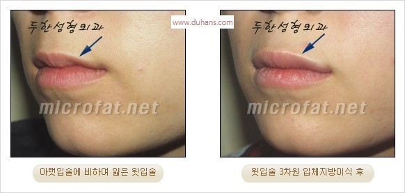 ​​[두한성형외과 경쟁력 미세지방이식] - [볼륨감 있는 입술성형] 관련 이미지 11