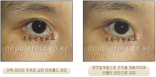 두한성형외과 쌍커풀 재수술 - 눈매교정 재수술 관련 이미지 69
