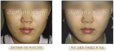 [두한성형외과 안전한 지방흡입] - [얼굴지방흡입] 관련 이미지 23