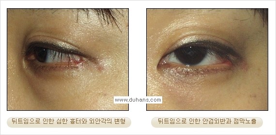 [두한성형외과 경쟁력 쌍꺼풀 재수술, 극한 눈재수술] - [뒤트임 수술의 부작용 안내] 관련 이미지 4