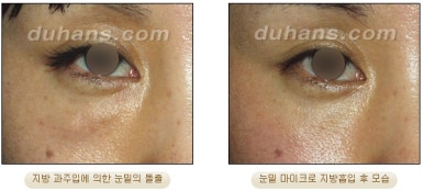 [두한성형외과 안전한 지방흡입] - [얼굴지방흡입] 관련 이미지 26