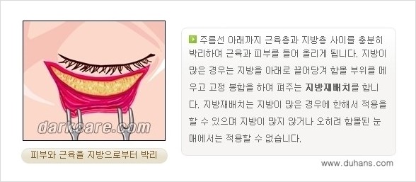 [두한성형외과 경쟁력 다크써클 교정] - [젊어 보이면서 개선된 인상을 주는 하안검 성형술] 관련 이미지 6