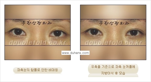[두한성형외과 경쟁력 눈성형] - [미세지방이식으로 비대칭 쌍꺼풀 라인의 교정 방법 안내] 관련 이미지 2