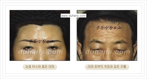 [두한성형외과 경쟁력 주름성형] - [볼처짐 개선, 이마주름 개선을 위한 엔도타인 리프팅 안내] 관련 이미지 1