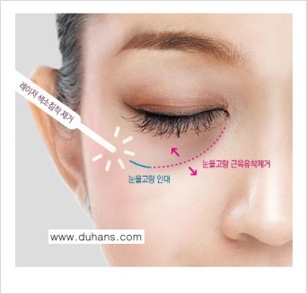 [두한성형외과 젊은 눈매 안검성형] - [눈밑 지방제거의 수술 전후 안내 ①] 관련 이미지 1