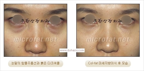 [두한성형외과 경쟁력 눈밑성형] - [눈밑이 전반적으로 함몰된 다크써클 교정 안내] 관련 이미지 7