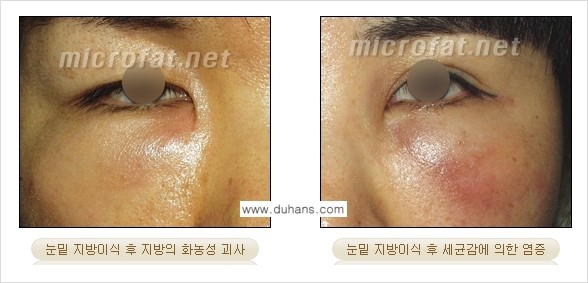 [두한성형외과 경쟁력 미세지방이식] - [타병원에서의 미세지방이식 이후 부작용 교정의 대상 안내] 관련 이미지 8