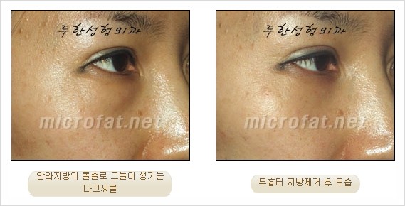 [두한성형외과 쌍커풀수술] - [눈성형 방법에 대한 자주하는 질문과 답변] 관련 이미지 173