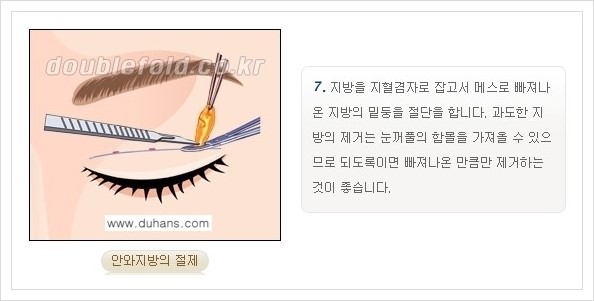 [두한성형외과 경쟁력 쌍꺼풀 재수술, 극한 재수술] - [쌍꺼풀 재수술의 과정 안내 1.] 관련 이미지 18