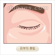 [두한성형외과 경쟁력 동안성형 리더] - ​[미간주름, 이마주름, 안검성형, 이마거상술, 눈썹거상술] 관련 이미지 64