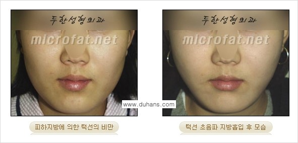 ​[두한성형외과 가을엔 지방흡입을] - [볼살, 눈밑, 턱선 초음파 미세지방흡입] 관련 이미지 10