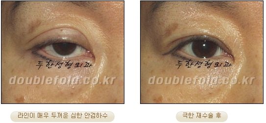 [DoubleFold Plastic Surgery Eye Surgery] - [Revision Surgery for Thick Double Eyelids] image 49