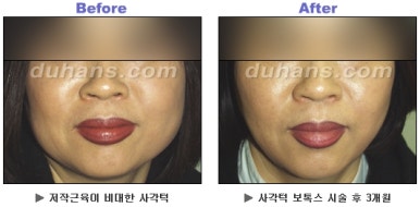 [Duhan Plastic Surgery Clinic Aesthetic Procedures] - [Square Jaw Botox] image 22