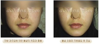 [두한성형외과 안전한 지방흡입] - [얼굴지방흡입] 관련 이미지 18