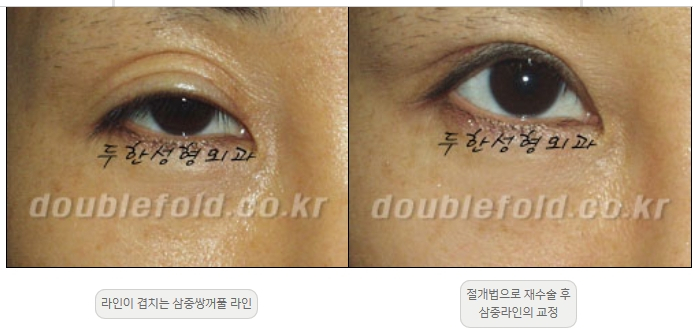 [Double Eyelid Surgery Duhan Plastic Surgery] - [Revision Methods] image 22