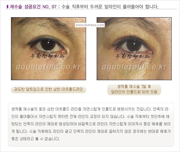 [두한성형외과 경쟁력 쌍꺼풀 재수술, 극한 재수술]- [쌍꺼풀 재수술의 성공 조건(Condition of successful reoperation) 관련 이미지 9