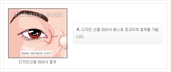 [두한성형외과 경쟁력 눈성형] - [앞트임 수술(몽고주름 제거) 안내 ②] 관련 이미지 4