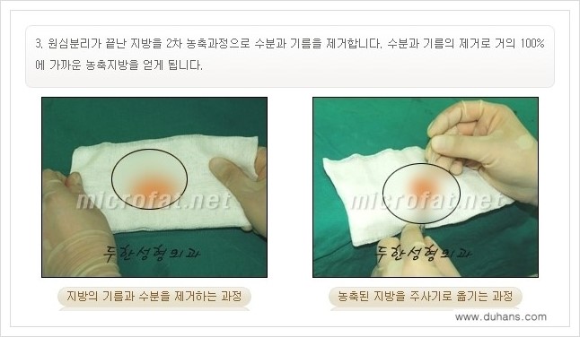 [두한성형외과 경쟁력 미세지방이식] - [귀족수술과 인디언밴드(앞광대주름) 미세지방이식] 관련 이미지 8