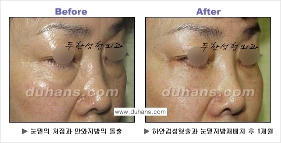 [두한성형외과의 상큼하고 환한 젊은 눈매완성] - [하안검 성형술 ①] 관련 이미지 23