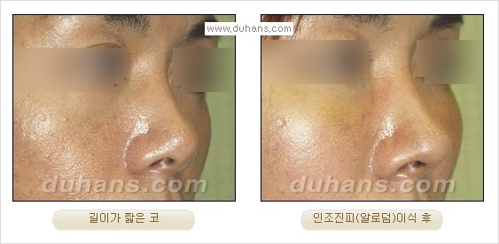 [두한성형외과 경쟁력 코성형] - [코성형을 위한 알로덤(슈어덤) 수술, 실리콘 수술 안내] 관련 이미지 14