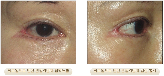 [Duhan Plastic Surgery Double Eyelid Revision] - [Inner Corner Revision, Outer Corner Revision] image 10
