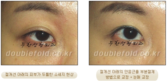 [Duhan Plastic Surgery Double Eyelid Revision Surgery] - [Ptosis, sausage eyelids] image 31