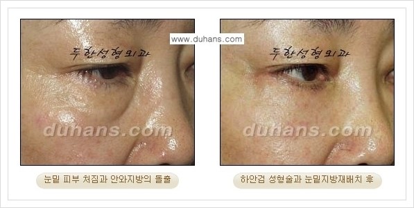 [두한성형외과 경쟁력 눈성형] - [젊은 눈매로의 복원 안검성형] 관련 이미지 39