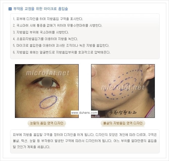 [두한성형외과 경쟁력 미세지방이식] - [타병원에서의 미세지방이식 부작용 교정 방법 안내] 관련 이미지 1