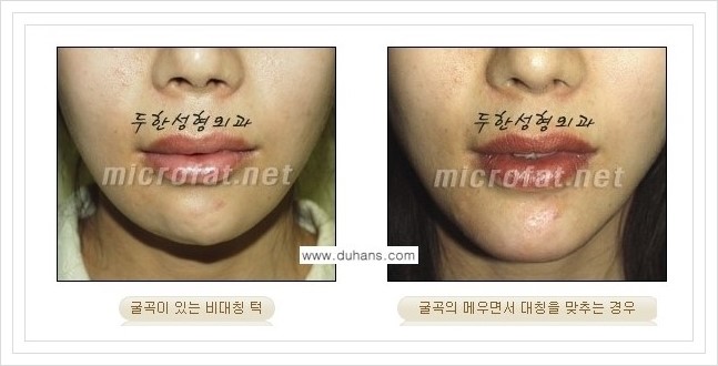 ⁠⁠[두한성형외과 경쟁력 미세지방이식] - [턱 미세지방이식 - 안면윤곽 교정 안내] 관련 이미지 4