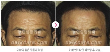 [눈밑수술 두한성형외과] - [다크서클 콤비프로그램] 관련 이미지 144