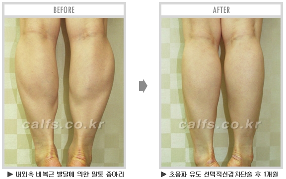 [종아리성형 두한성형외과] - [종아리수술에 대한 자주하는 질문과 답변 모음] 관련 이미지 53