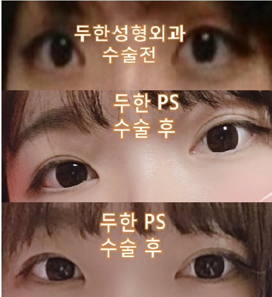 [두한성형외과 쌍꺼풀 재수술]-[#풀린눈 #쌍꺼풀풀림 #비대칭 #쌍꺼풀짝짝이 #쌍꺼풀비대칭] 관련 이미지 1