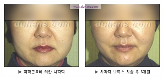 [두한성형외과 경쟁력 안면윤곽 성형 리더] - [완변한 V 라인! 턱 미세지방이식, 볼살 미세지방이식, 사각턱 보톡스 안내] 관련 이미지 31