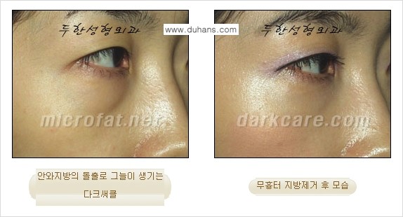 [두한성형외과 경쟁력 "지방제거"] - [눈 지방제거 2.] 관련 이미지 8
