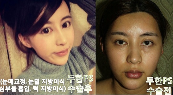 [두한성형외과 수술]-[#눈매교정 #눈밑지방이식 #턱지방이식 #심부볼흡입] 관련 이미지 1