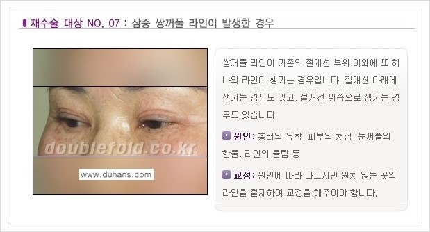 ⁠⁠[두한성형외과 경쟁력 쌍꺼풀 재수술, 극한 재수술] - [쌍꺼풀 재수술이 필요한 경우 안내] 관련 이미지 8