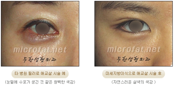 [두한성형외과 지방이식] - [다크서클, 눈밑주름] 관련 이미지 97