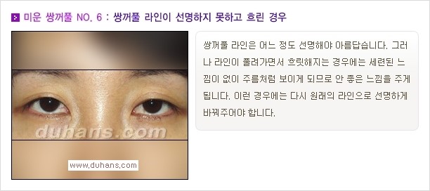 [두한성형외과 경쟁력 쌍꺼풀 재수술, 극한 눈재수술] - [자연스러운 눈매로의 복원 쌍꺼풀 재수술 대상 안내] 관련 이미지 7